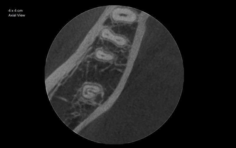 Ejemplo del fabricante: vista axial, campo de visión 4 × 4 cm