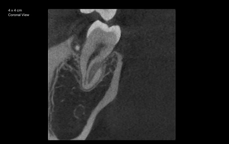 Ejemplo del fabricante: vista coronal, campo de visión 4 × 4 cm